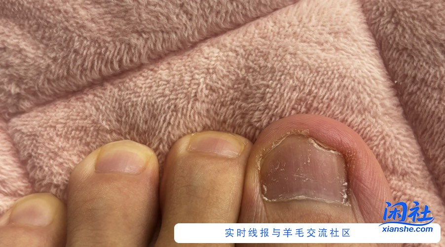 给大家推荐一个灰指甲的药吧，便宜，有用，亲测