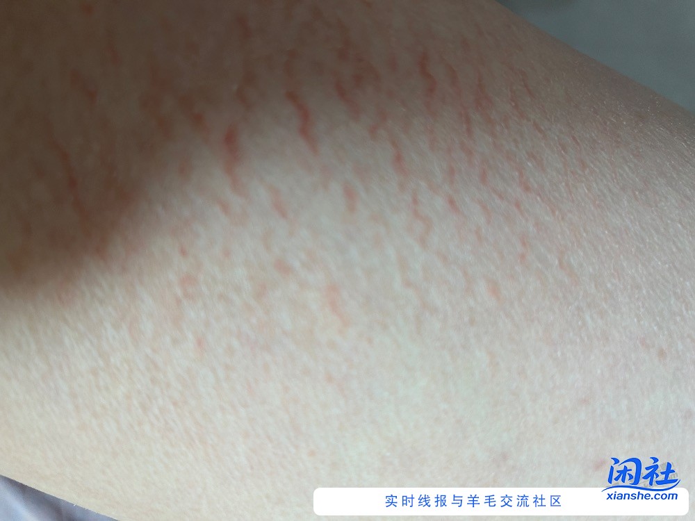 吧友们，大腿内侧这些是什么，一周了还没消下去